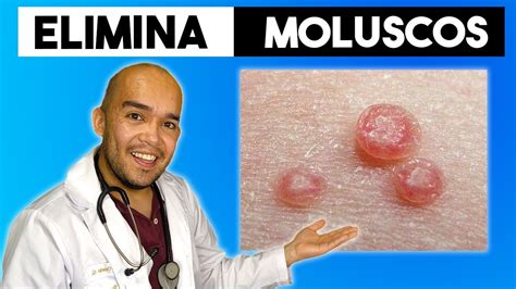 como eliminar molusco contagioso naturalmente